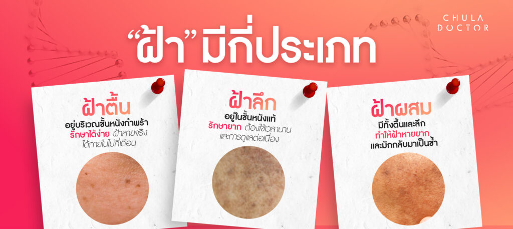 ทำความเข้าใจประเภทของฝ้าก่อนเริ่ม รักษาฝ้า