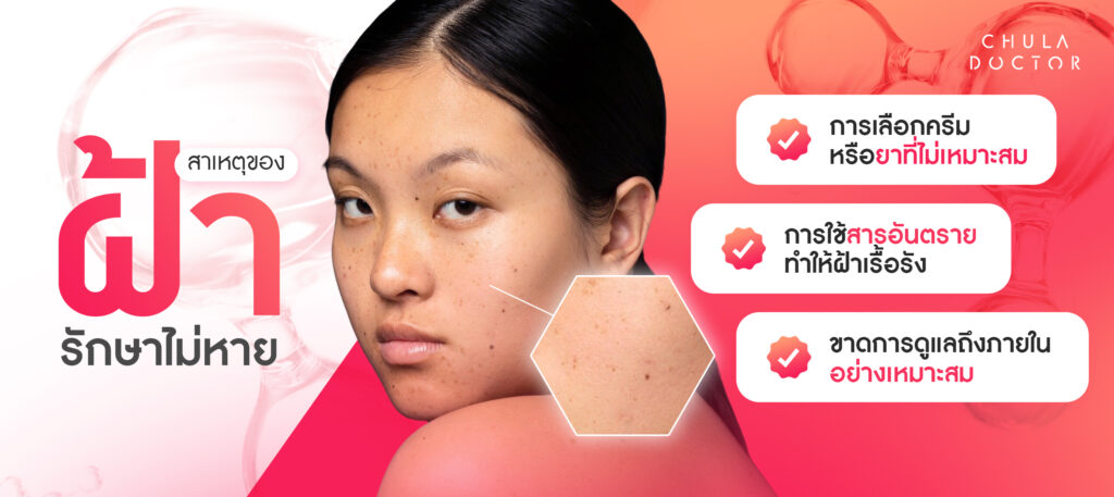 สาเหตุของฝ้ารักษาไม่หาย เพราะอะไร ลองอ่านให้เข้าใจก่อนเริ่มรักษาฝ้า