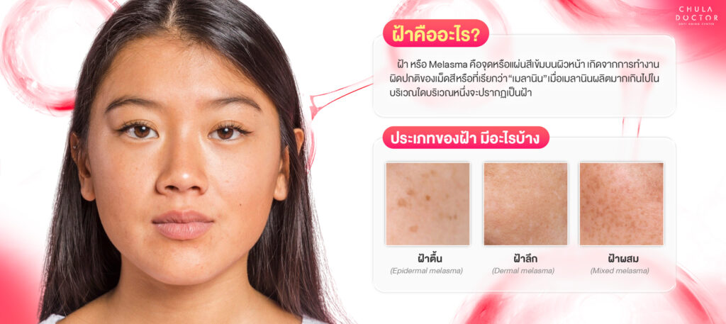 ฝ้าคืออะไร และประเภทของฝ้ามีอะไรบ้าง