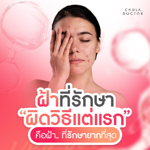 ฝ้าที่รักษาผิดวิธีแต่แรกคือฝ้าที่รักษายากที่สุด