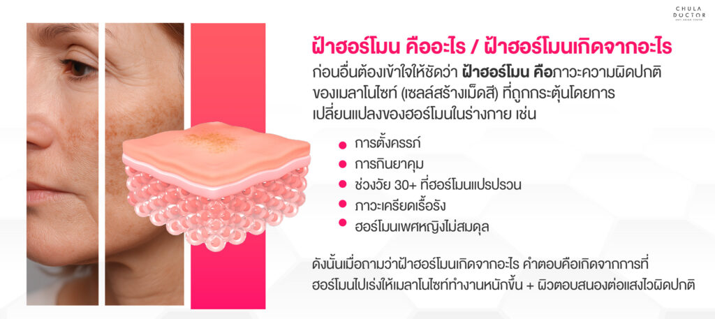 ฝ้าฮอร์โมนคืออะไร และปัจจัยที่ทำให้เกิดฝ้าฮอร์โมนมีอะไรบ้าง?