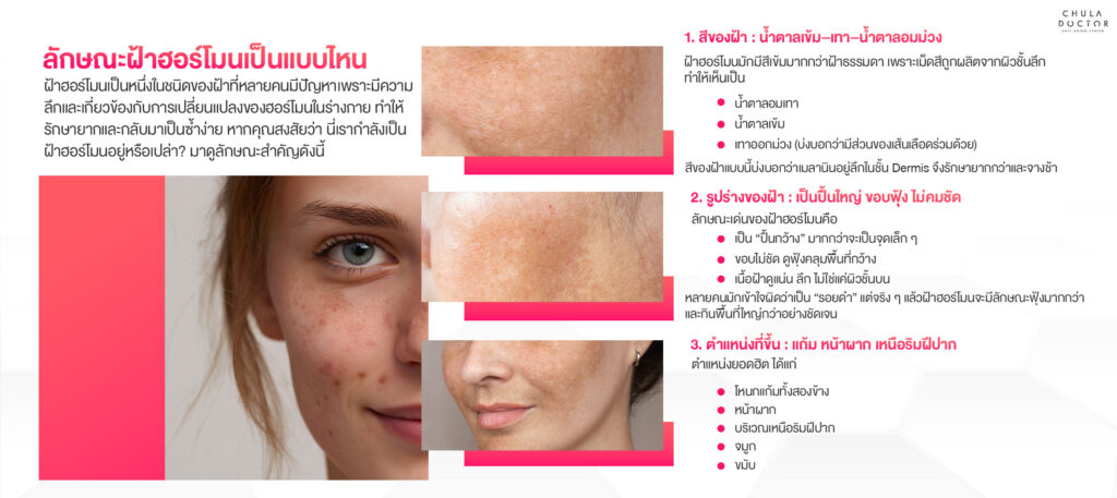 ดูความแตกต่างของฝ้าฮอร์โมนในแต่ละหัวข้อ