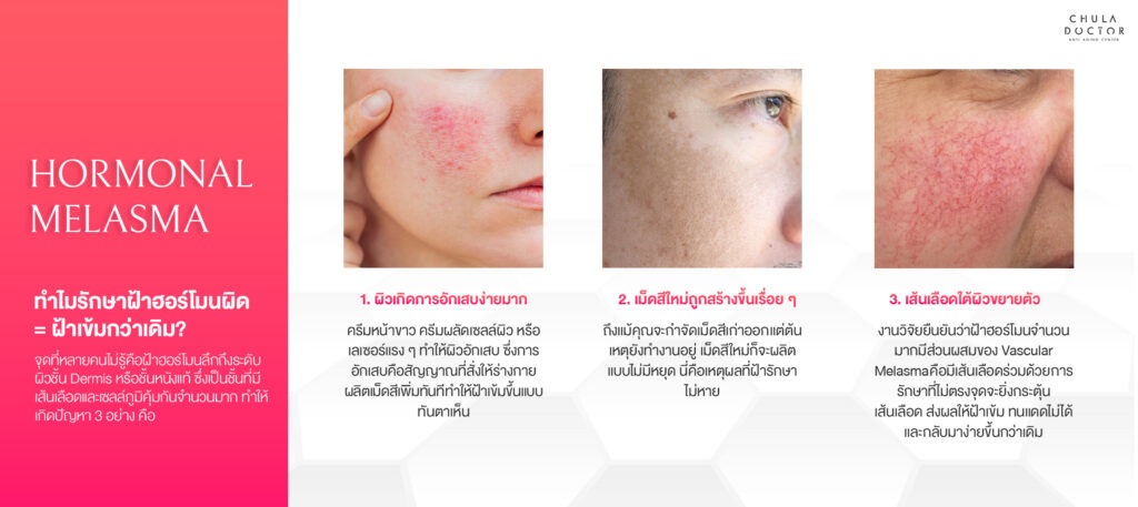 ทำไมรักษาฝ้าฮอร์โมนผิด = ฝ้าเข้มกว่าเดิม