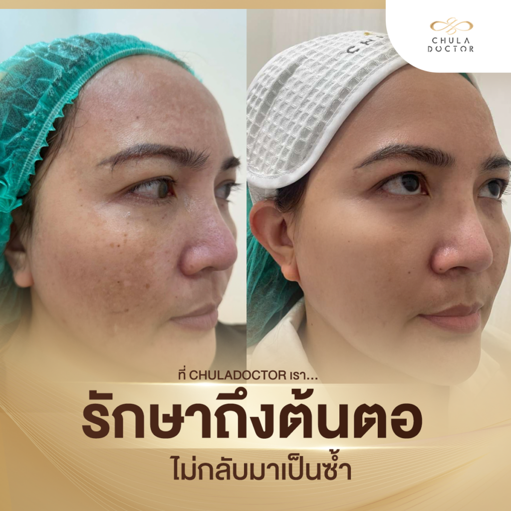 รักษาฝ้า