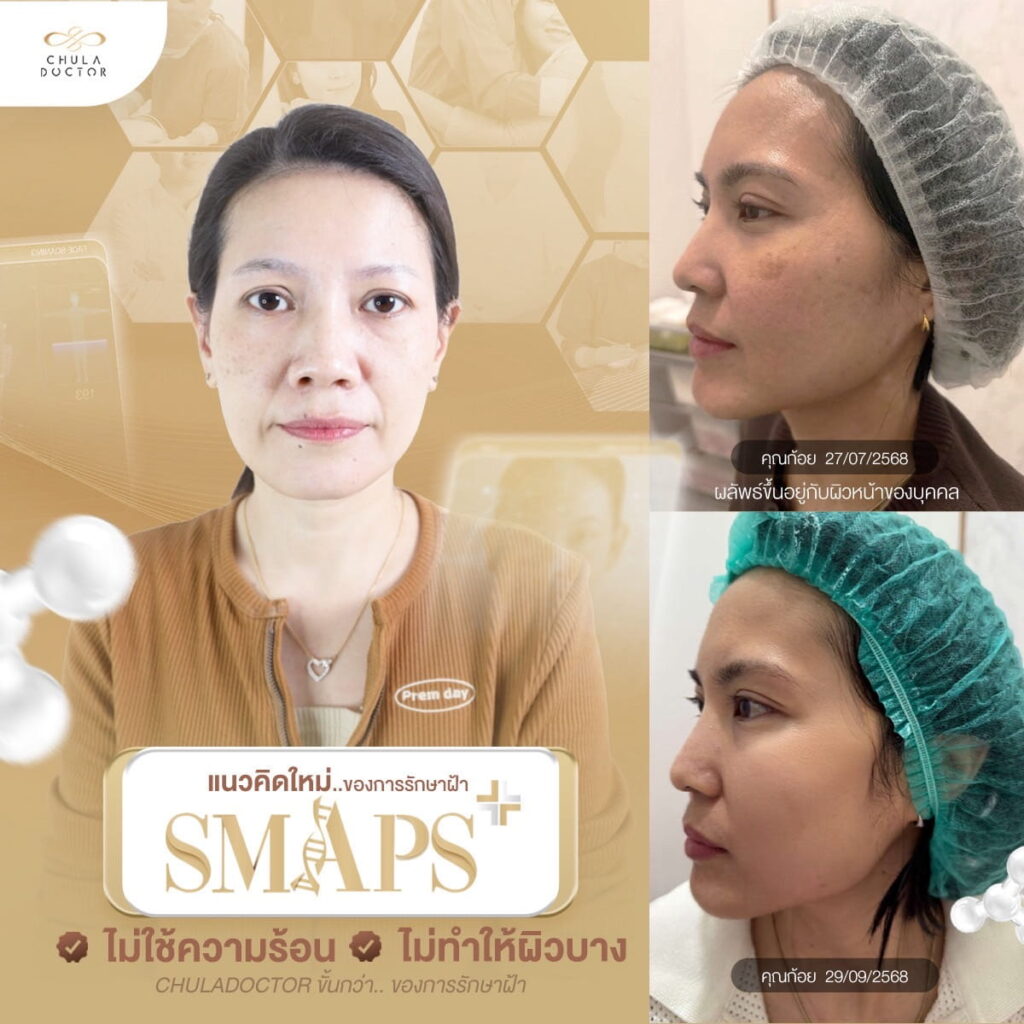 รักษาฝ้า