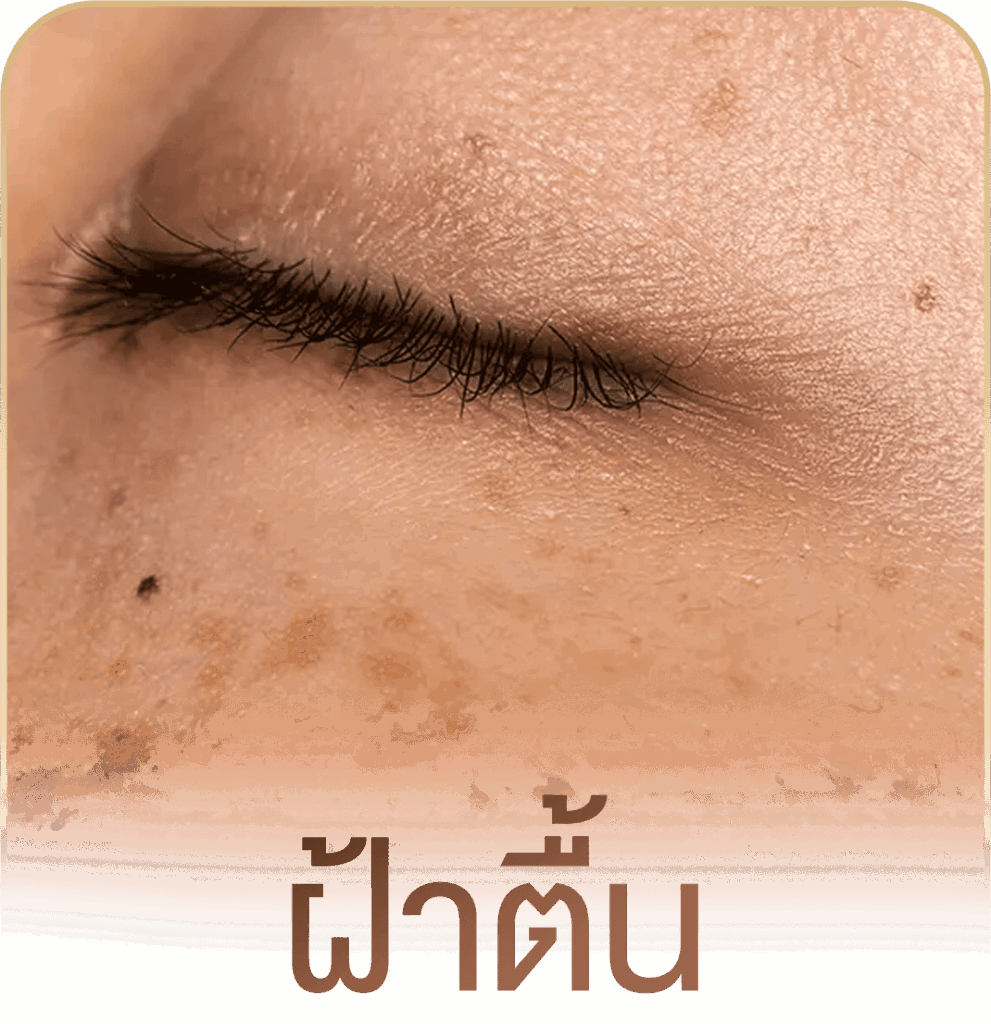 รักษาฝ้า