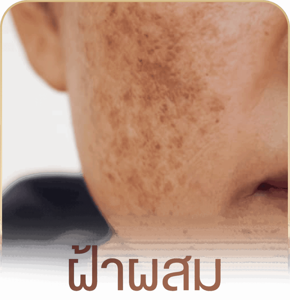 รักษาฝ้า