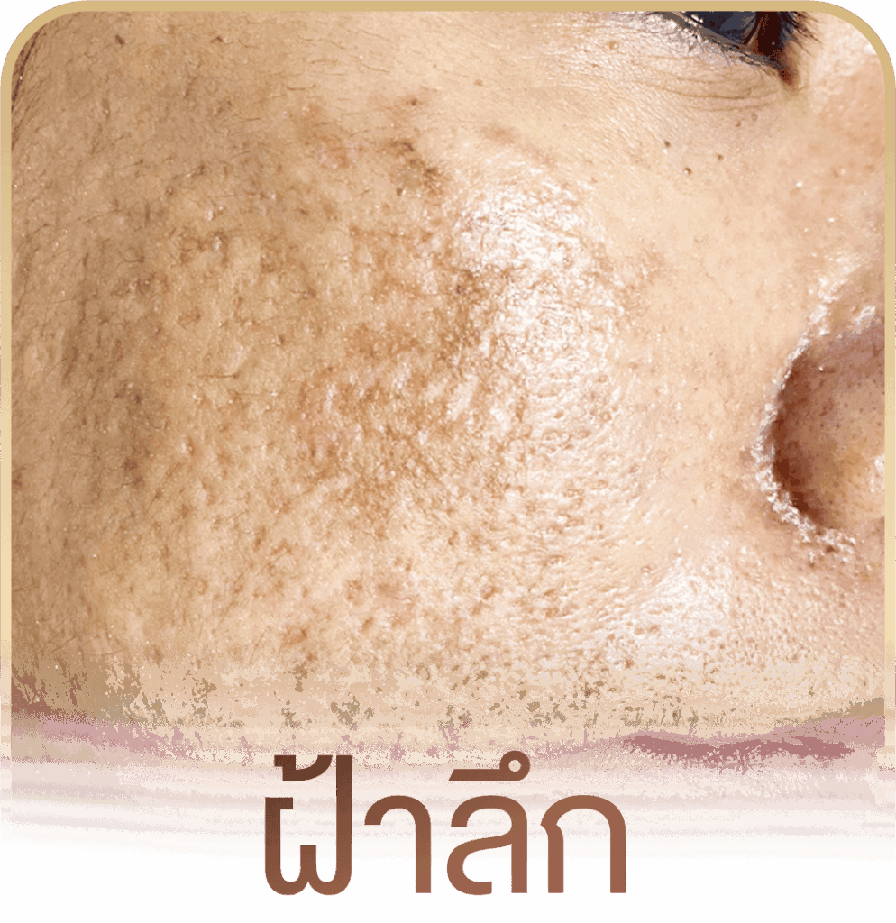 รักษาฝ้า