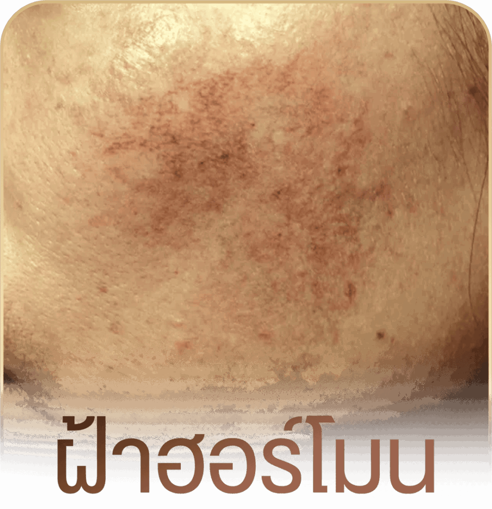 รักษาฝ้า