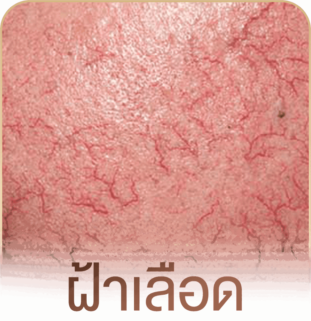 รักษาฝ้า