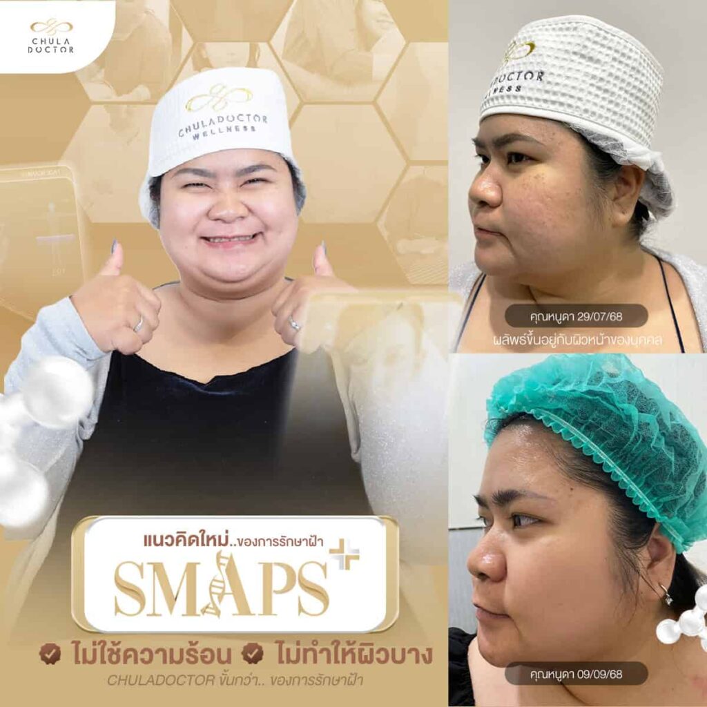 รักษาฝ้า