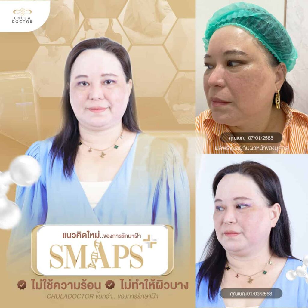 รักษาฝ้า