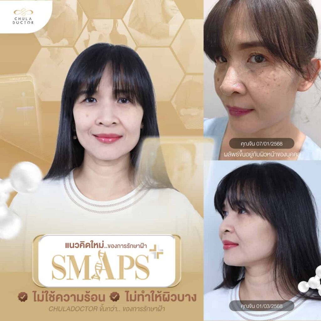 รักษาฝ้า