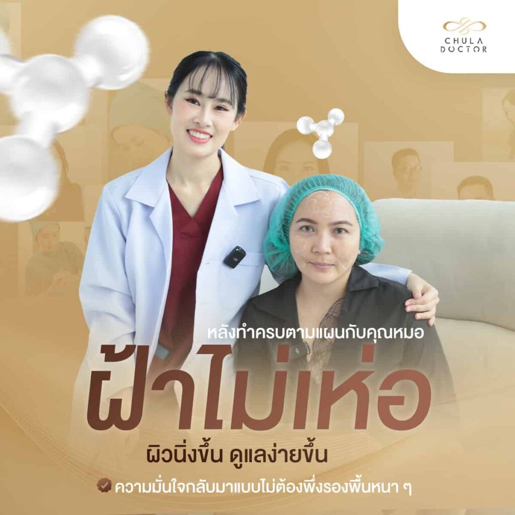 รักษาฝ้า