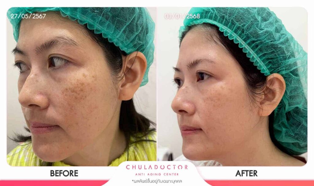 ผลการรักษาฝ้า 10