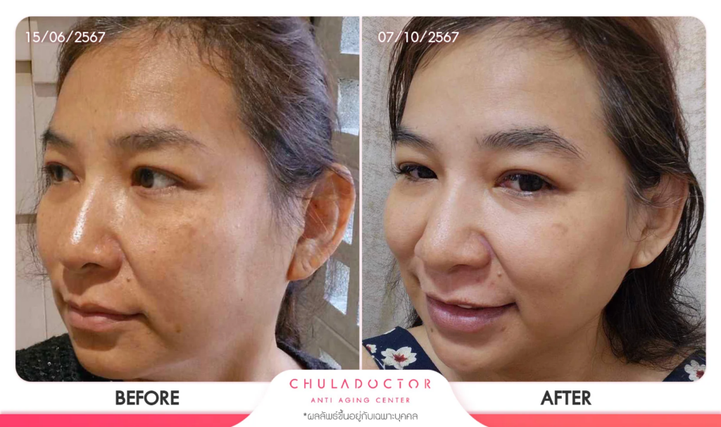 รีวิว รักษาฝ้า 1