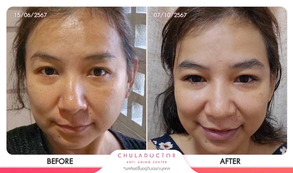 รีวิว รักษาฝ้า 2