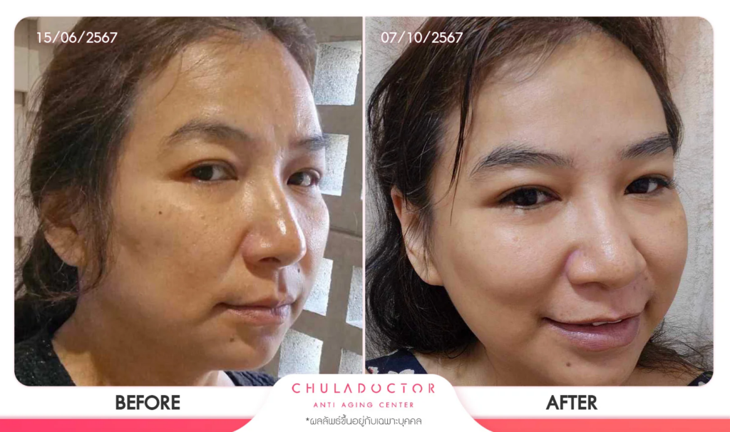 รีวิว รักษาฝ้า 3