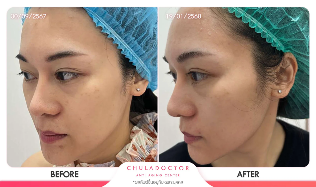 รีวิว รักษาฝ้า 4