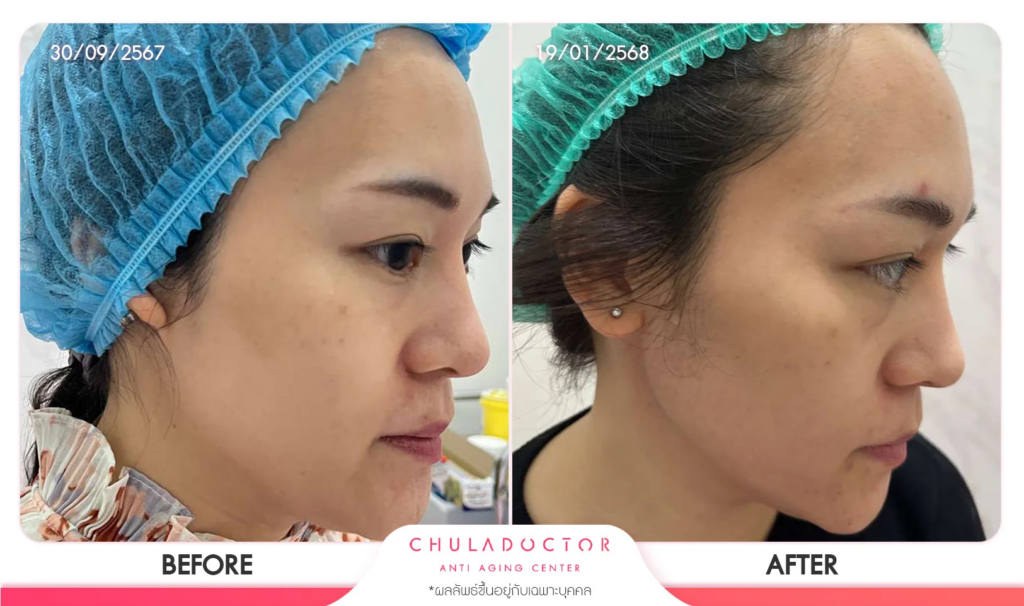 รีวิว รักษาฝ้า 6