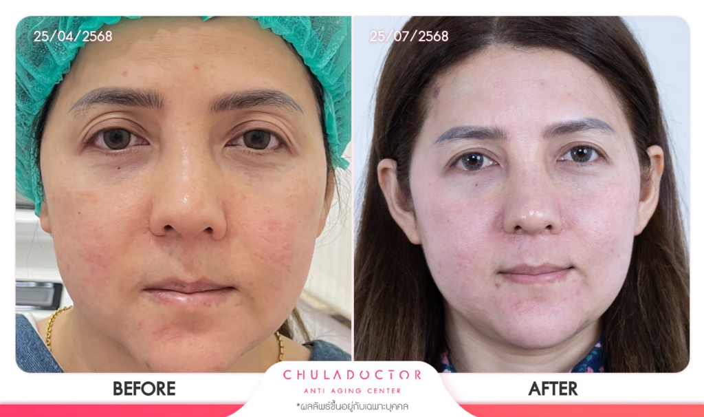 รีวิว รักษาฝ้า 8