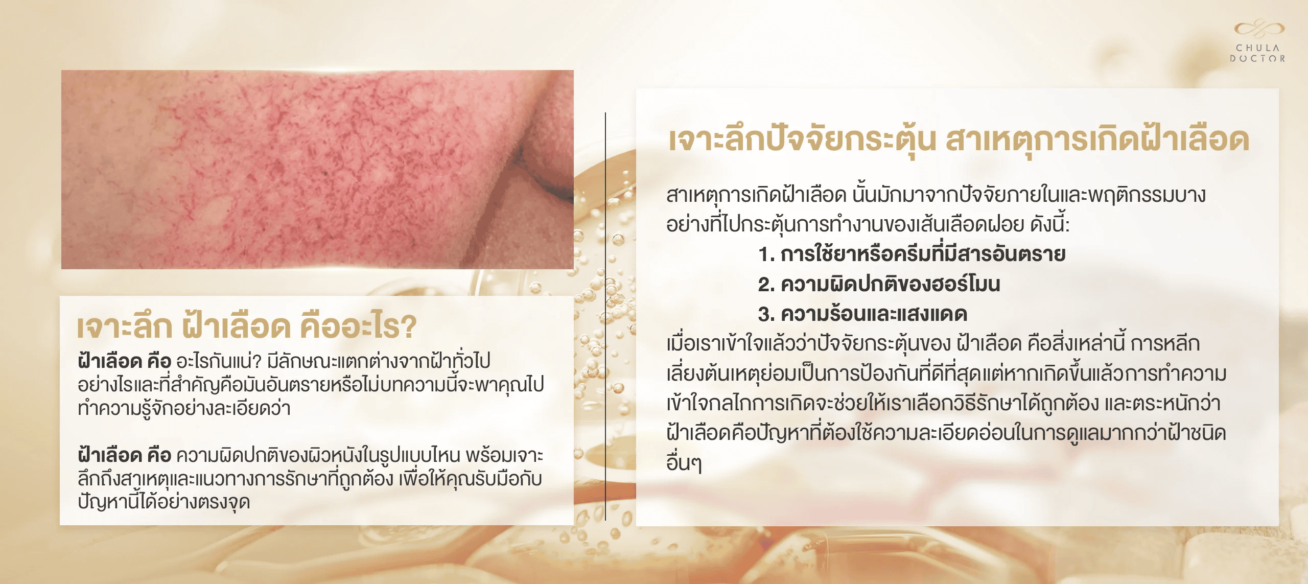 เจาะลึกปัจจัยกระตุ้นและ สาเหตุการเกิดฝ้าเลือด ที่ทำให้เข้าใจว่า ฝ้าเลือด คืออะไร