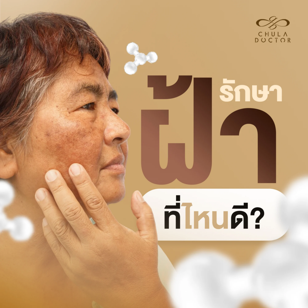 รักษาฝ้าที่ไหนดี? เจาะลึกนวัตกรรม “สเต็มเซลล์” รักษาฝ้าให้หายไว ไม่กลับมาเป็นซ้ำ