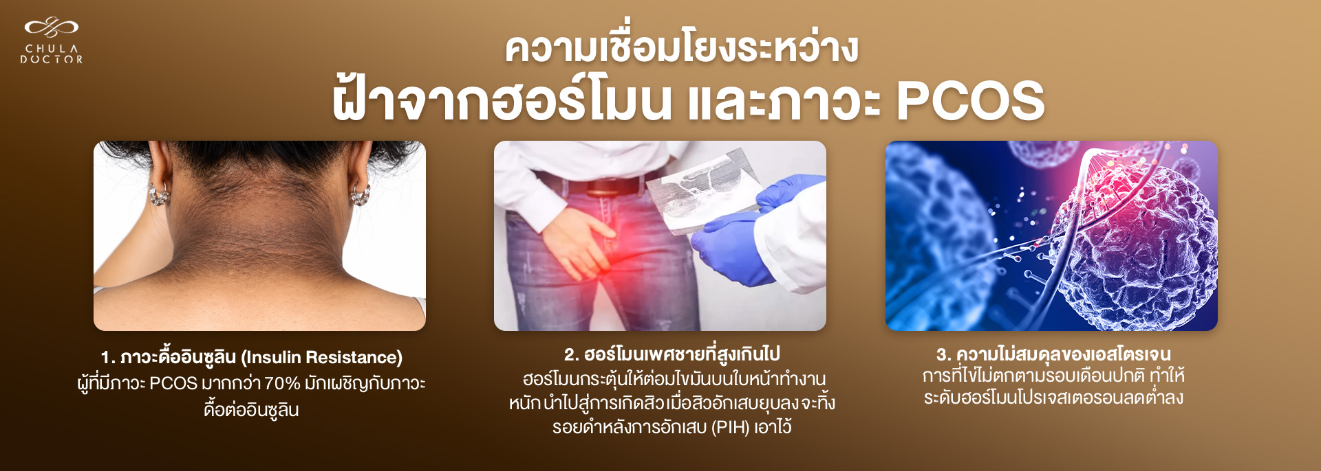 ความเชื่อมโยงระหว่างฝ้าจากฮอร์โมนและภาวะ PCOS