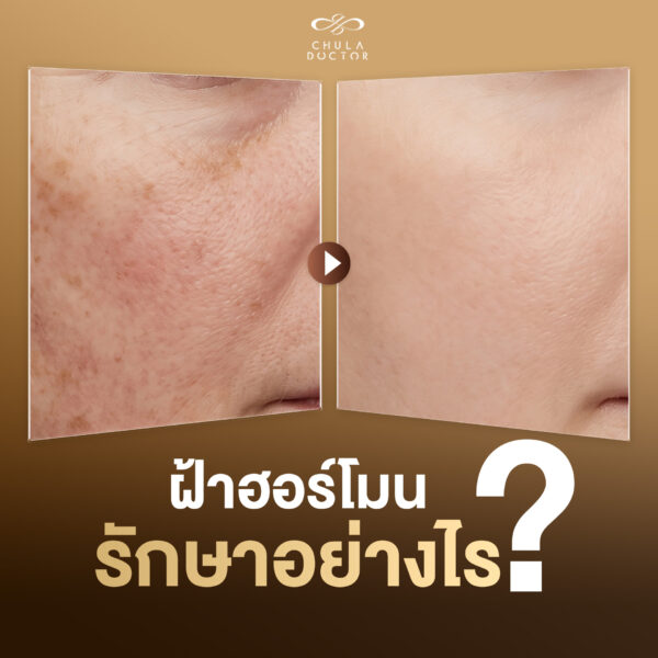 ฝ้าจากฮอร์โมน รักษาอย่างไร