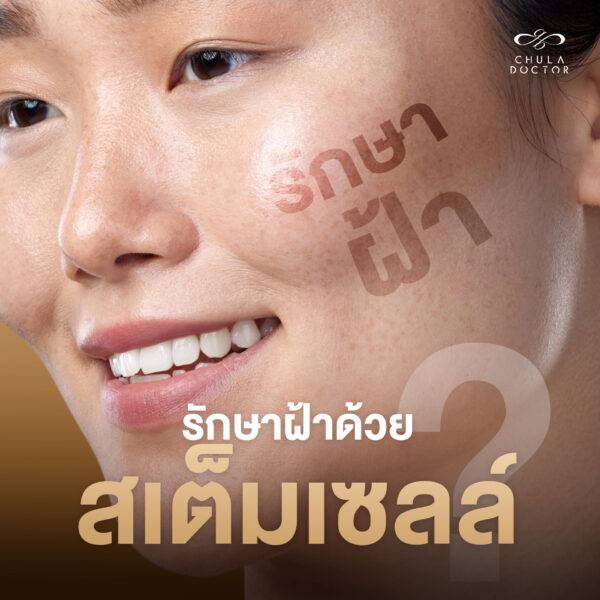 รักษาฝ้าด้วยสเต็มเซลล์